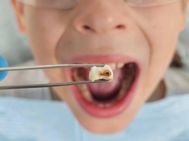 Best Broken or Cracked Tooth Emergency Dentist in Kent, WA